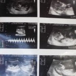 ultrasonido 11 14 semanas