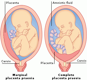 placenta previa primer trimestre