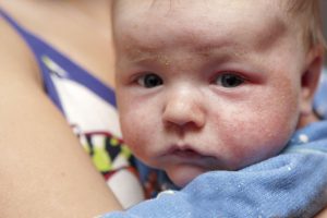 Alergias alimentarias en bebés y niños